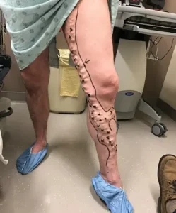 My varicose veins during the preoperative stage